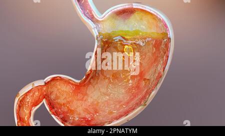 estomac humain avec gaz. Ballonnements et flatulences, flatulences et tractus gastro-intestinal, ballonnement du système de digestion, maux d'estomac ou crampes, gastrite Banque D'Images