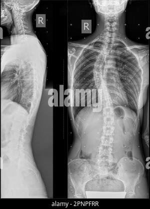Radiographie panoramique du rachis en deux projections. Déformation du côté droit d'un seul arc de la colonne thoracique. déséquilibre coronaire. Rayons X du rachis avec c Banque D'Images