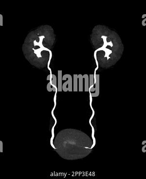 CTA image de rendu de l'artère rénale 3D montrant les deux reins, l'uretère et la vessie . Banque D'Images