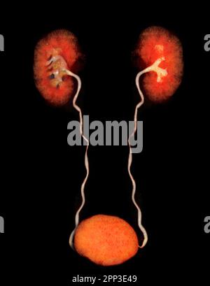 CTA image de rendu de l'artère rénale 3D montrant les deux reins, l'uretère et la vessie . Banque D'Images