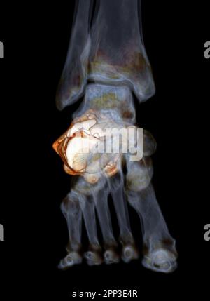 CT scanner l'articulation de la cheville avec un rendu 3D de l'os calcanéus montrant des fractures de Calcanéum (Heel Bone). Banque D'Images