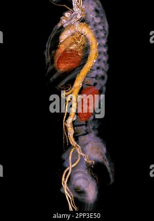 Rendu de l'aorte complète CTA 3D. Banque D'Images