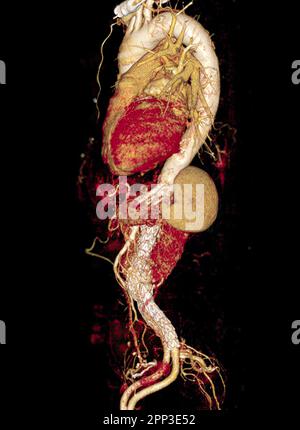 CTA de l'aorte avec greffe de stent dans l'anévrisme aortique abdominal du patient. Banque D'Images