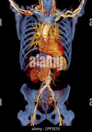 CTA de l'aorte avec greffe de stent dans l'anévrisme aortique abdominal du patient. Banque D'Images