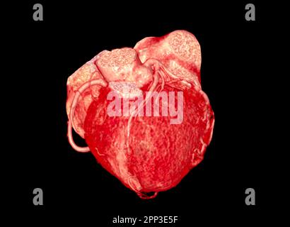 Image de rendu de l'artère coronaire CTA 3D. Banque D'Images