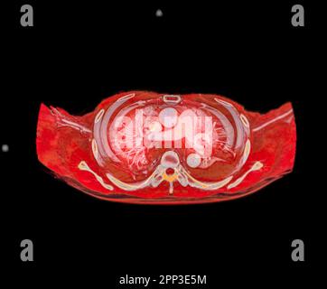 CTA artères pulmonaires 3D rendu montrant la branche de l'artère pulmonaire Banque D'Images