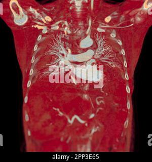 CTA artères pulmonaires 3D rendu montrant la branche de l'artère pulmonaire Banque D'Images