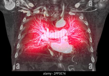 CTA artères pulmonaires 3D rendu montrant la branche de l'artère pulmonaire Banque D'Images