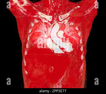 CTA artères pulmonaires 3D rendu montrant la branche de l'artère pulmonaire Banque D'Images