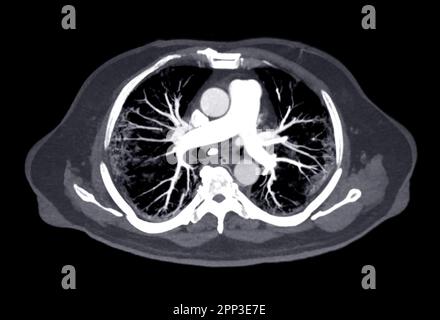 CTA artères pulmonaires 3D rendu montrant la branche de l'artère pulmonaire Banque D'Images