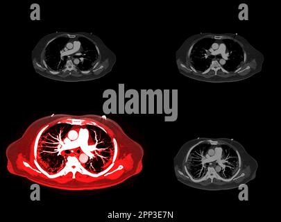 CTA artères pulmonaires 3D rendu montrant la branche de l'artère pulmonaire Banque D'Images