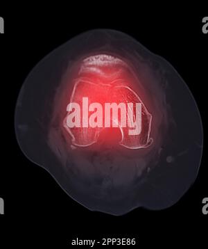 Acquisition CT de l'articulation du genou montrant une fracture de l'os du fémur distal. Banque D'Images