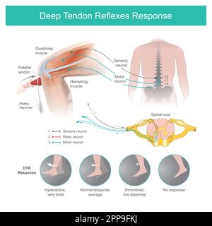 Deep Tendon réflexes réponse. Le médecin testant les systèmes nerveux par un marteau Reflex en utilisant le cognement sur le tendon dans la zone du genou causant le tibia à Illustration de Vecteur