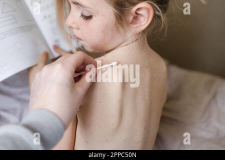 Petite fille assise avec son dos à la caméra et regardant le traitement des ulcères de la varicelle, la varicelle avec la crème médicale. Enfant avec une sittine rouge Banque D'Images