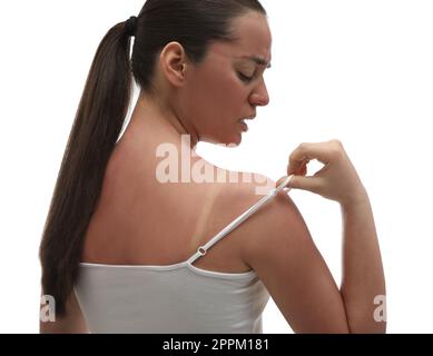 Femme avec une peau brûlée de soleil sur fond blanc Banque D'Images