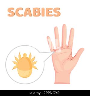 Sarcoptes scabiei. Gale. Maladie sexuellement transmissible. Infographies. Illustration sur un arrière-plan isolé. Illustration de Vecteur