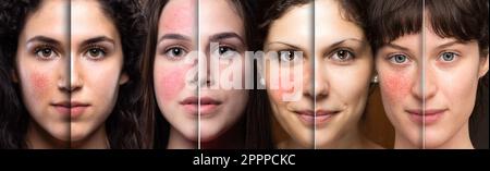 Collage des visages des femmes montrant avant et après le traitement au laser pour la rosacée. Demi-faces avec et sans peau rougeâtée en raison de la coupe Banque D'Images