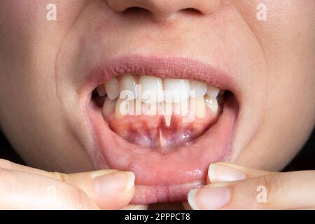 Macro d'une bouche femelle avec des gencives qui s'éloignent. Gros plan des dents d'une femme avec une gomme rouge enflammée et une rétraction évidente de la gomme. Cause primaire de pyorrhée an Banque D'Images