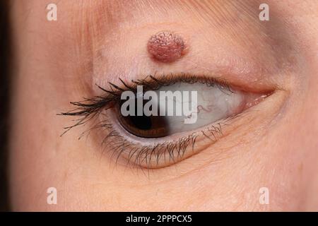 Un oeil de femme avec un nevus mélanocytique de paupière. Kyste de kératine sur la paupière, une masse semblable à un pailloome. Banque D'Images