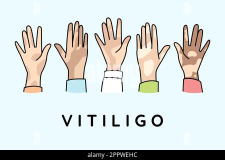 Les gens mains avec le vitiligo Illustration de Vecteur