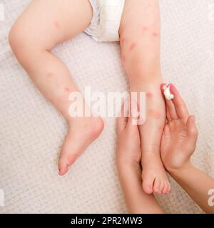 Soins de la peau, allergies et dermatites pour tout-petits. Une mère-femme sourit des taches rouges d'allergie et de dermatite atopique sur la peau de l'enfant avec de la crème. Enfant A. Banque D'Images