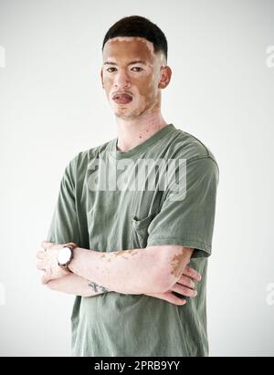 Vous êtes parfait exactement comme vous l'êtes. Studio portrait d'un jeune homme avec le vitiligo posant sur un fond blanc. Banque D'Images