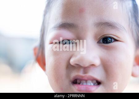 Fermé asiatique enfant petite fille oeil avec sty Banque D'Images