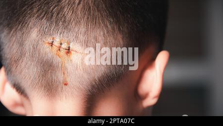 La plaie lacérée suturée de la tête du dos de l'enfant qui suture par suture en nylon environ 3 points de suture à la salle d'urgence de l'hôpital, soins médicaux de la Banque D'Images