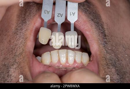 Fermez la bouche. Couleur des dents du médecin assortie à la palette. dentisterie esthétique Banque D'Images