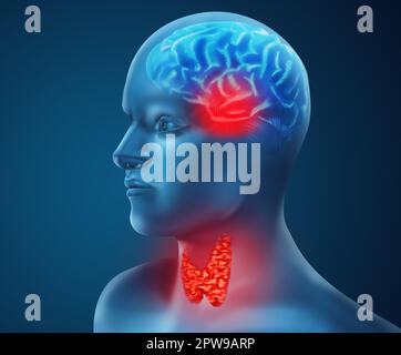 Illustration de l'homme avec une glande thyroïde enflammée sur fond de couleur Banque D'Images