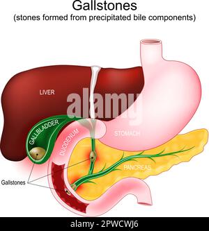 Calculs biliaires. cholécystolithiase quand la pierre dans la vésicule biliaire, la cholédocholithiase - la calculs biliaires bloque un canal biliaire. Parties d'un système digestif Illustration de Vecteur