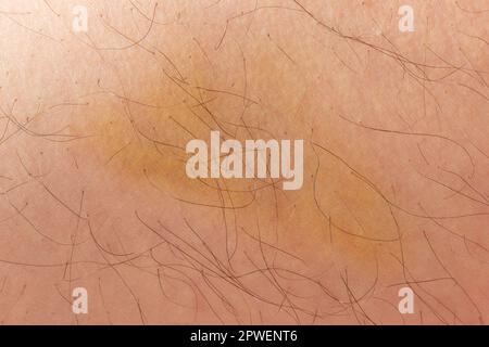 Hématome sur la peau humaine voiture jaune vue rapprochée Banque D'Images