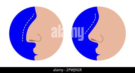 Comparaison du nez droit et du nez croqué, avant et après la correction de la rhinoplastie. Effet chirurgical du nez en plastique, illustration d'un vecteur médical, isolé sur fond blanc. Illustration de Vecteur