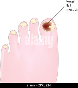 Infections fongiques des ongles Illustration de Vecteur