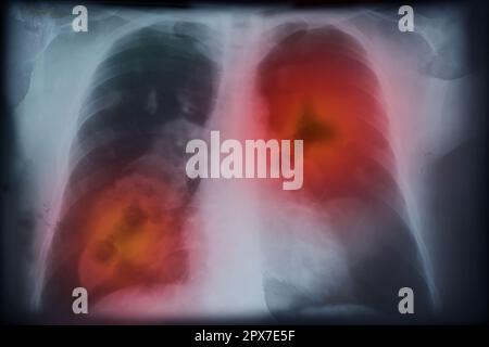 Image radiographique d'un patient atteint d'un cancer du poumon. Illustration Banque D'Images