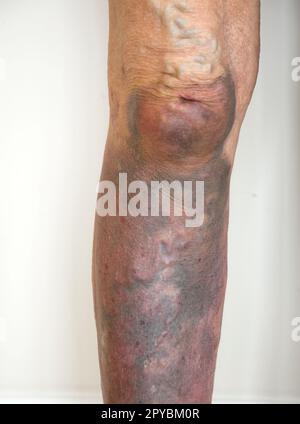 Ecchymoses de l'utérus de la jambe droite montrant des ecchymoses pourpres profondes du genou au pied UK Banque D'Images