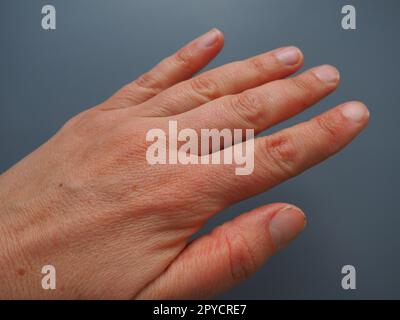 Main féminine avec peau atopique sèche. Fond blanc. Gros plan de la peau sur la paume et les doigts. Derma en besoin de soins et d'hydratation. Problèmes dermatologiques. Ongles naturels non peints Banque D'Images