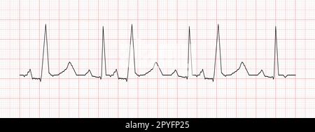 Diagramme des battements cardiaques noirs sur papier graphique rouge. Graphique ECG. Ligne de rythme cardiaque. Panneau de test cardio. Symbole de l'hôpital de cardiologie. Illustration graphique vectorielle Illustration de Vecteur