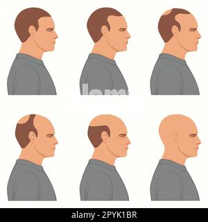 Tableau d'information montrant les étapes de la perte de cheveux pour les hommes. Tête de boulonnage de la couverture complète des cheveux à une dernière étape de la calvitie. Banque D'Images