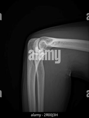 Articulation du coude saine, rayons X. Banque D'Images