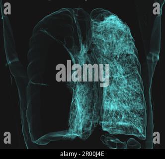 Bulla géant pulmonaire, TDM Banque D'Images