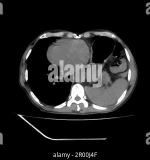 Hiatus hernia, CT scan Stock Photo