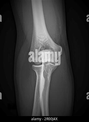 Articulation du coude saine, rayons X. Banque D'Images