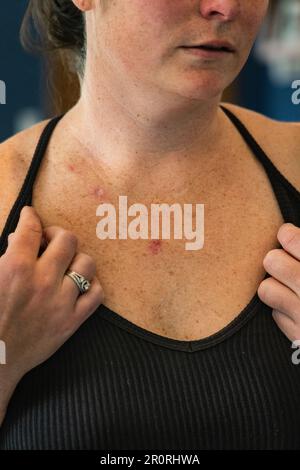 Jeune 30s une femelle caucasienne examine une plaie ouverte ulcérée d'un carcinome basocellulaire superficiel montrant une décoloration rouge sur sa poitrine. Banque D'Images