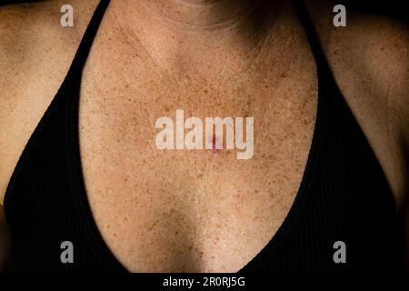 Vue horizontale du carcinome basocellulaire sur la poitrine de la jeune femme du Caucase 30s. Banque D'Images