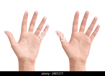 Collage avec des photos de femme montrant les mains avec une peau sèche et hydratée sur fond blanc, gros plan Banque D'Images