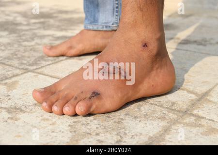 Montrant une blessure semi-séchée sur la jambe gauche d'un homme avec fond de sol en béton dans la lumière du jour . Concept médical et de santé Banque D'Images