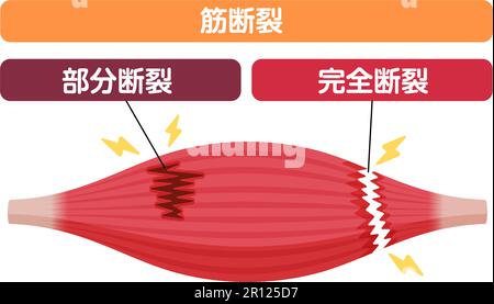 Illustration du vecteur de rupture musculaire (déchirures partielles et complètes ) Illustration de Vecteur