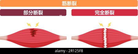 Illustration du vecteur de rupture musculaire (déchirures partielles et complètes ) Illustration de Vecteur