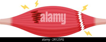 Illustration du vecteur de rupture musculaire (déchirures partielles et complètes ) Illustration de Vecteur